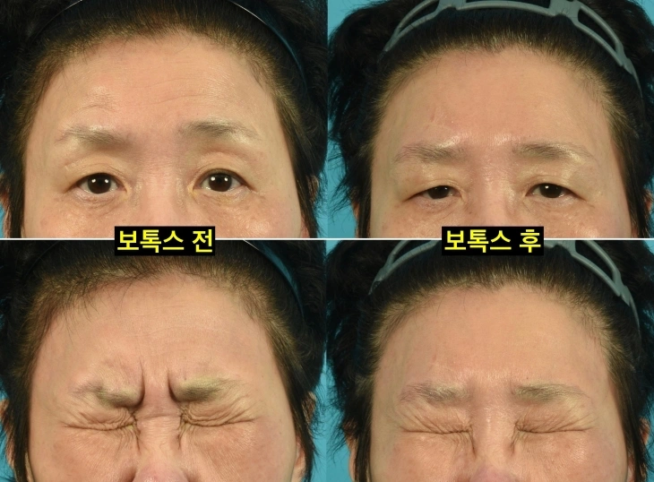 이마보톡스 후 눈 뜨기 불편한 사례