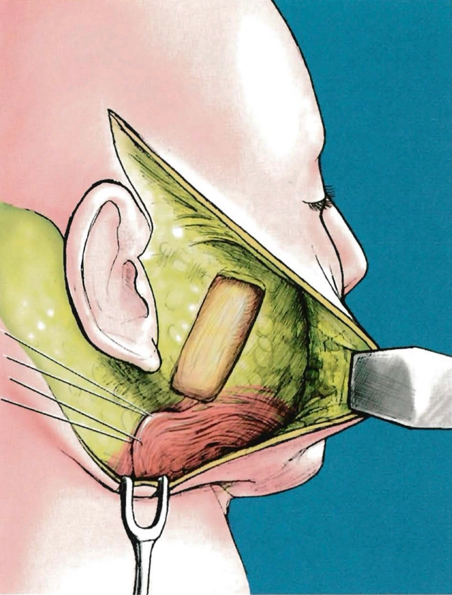 Lateral SMASectomy