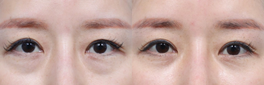 best lower blepharoplasty surgeon in Seoul