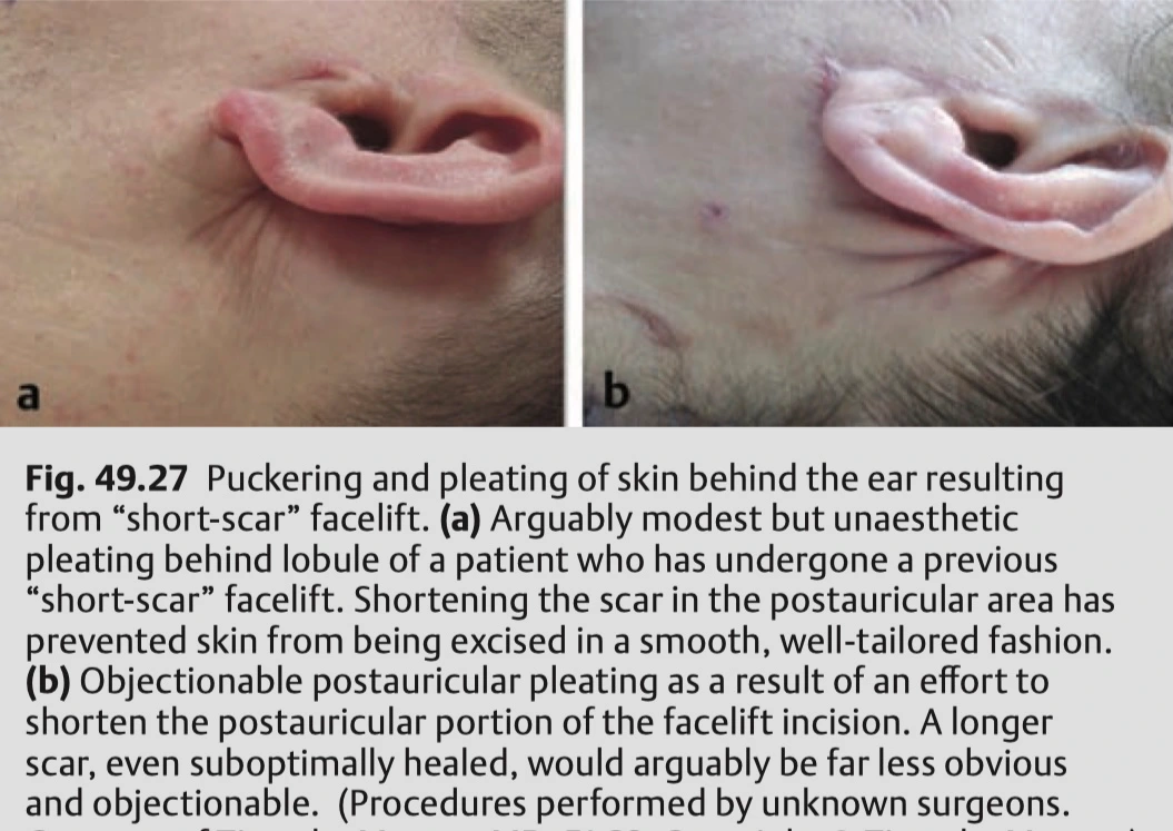 mini facelift side effects