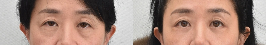 fat graft for lower eyelid hollowness