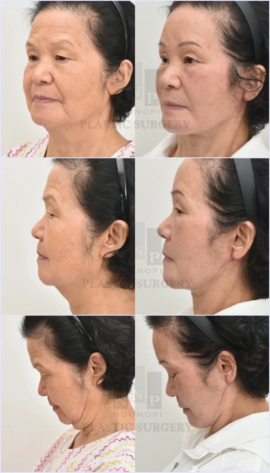 facelift aftercare tips