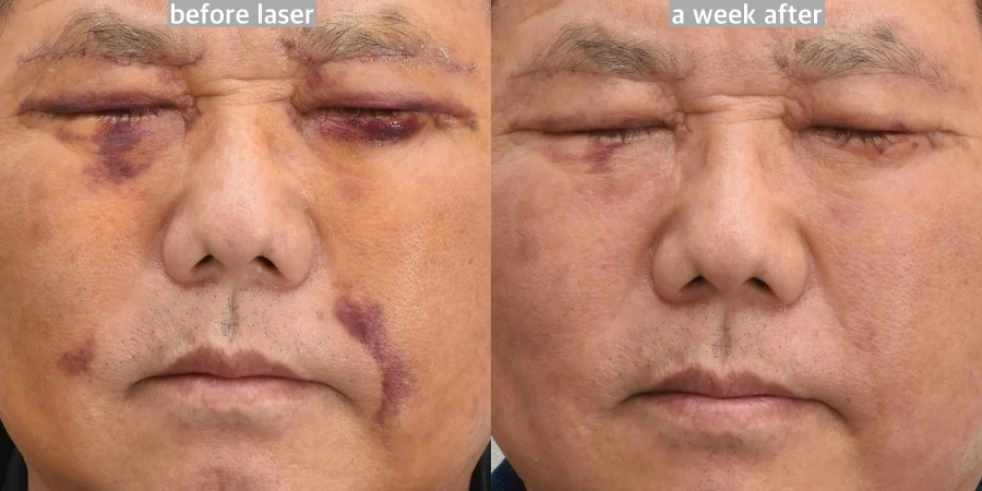 example of plastic surgery bruises treated with laser