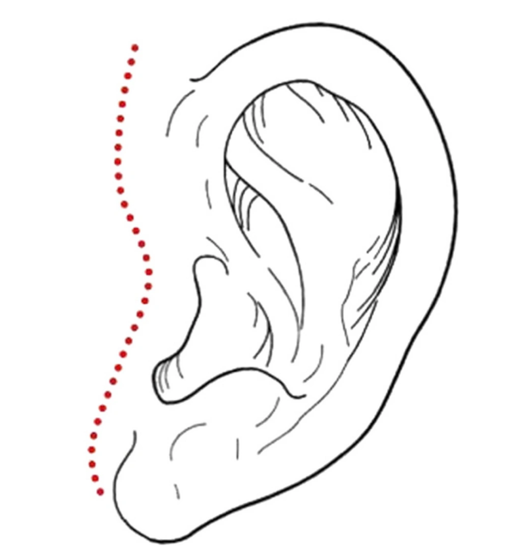 anterior tragus incision