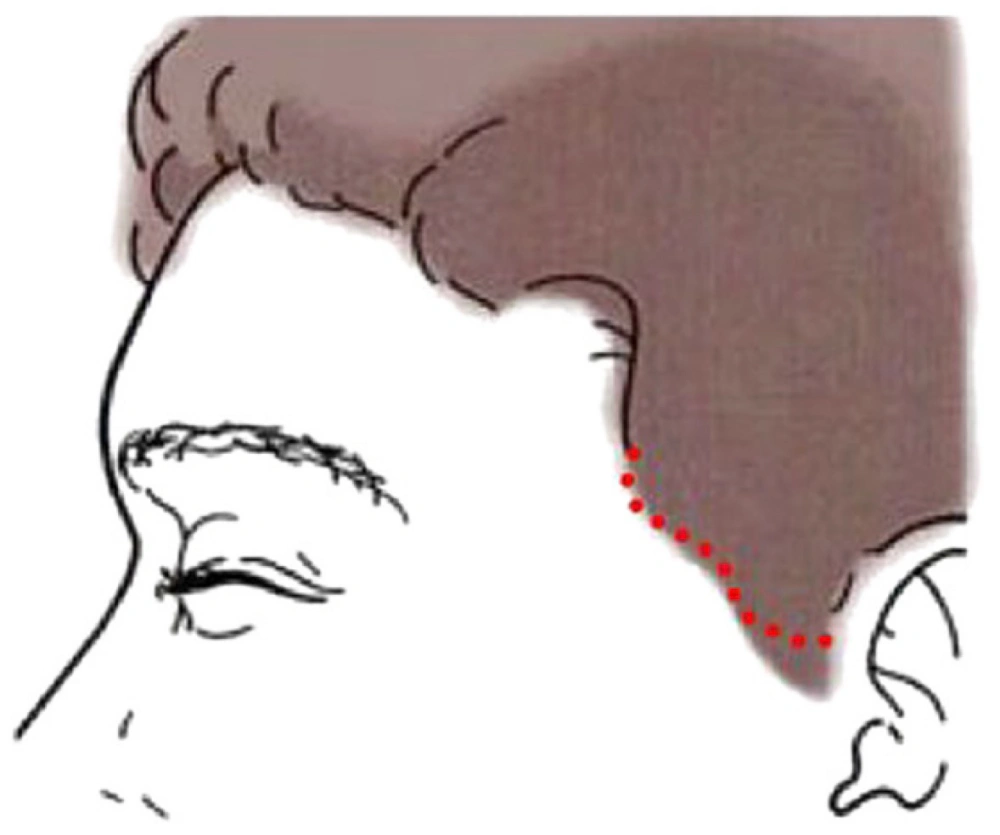 Hairline incision and along-hairline placement comparison