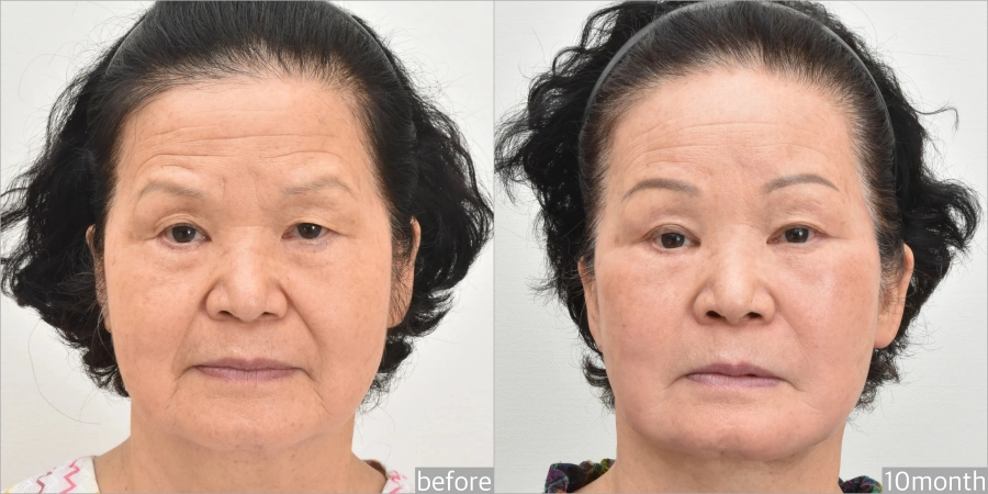 before and after Asian facelift - high SMAS vs deep plane