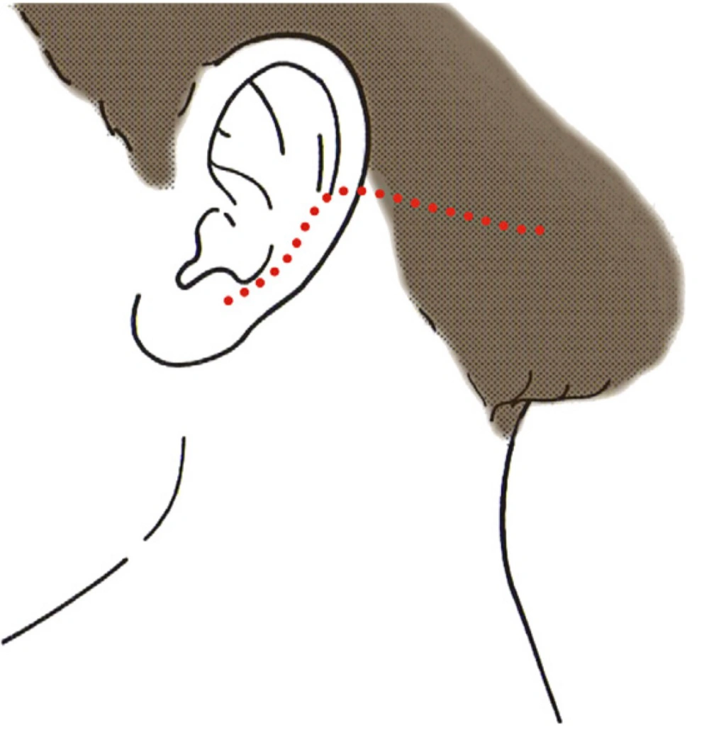 Inside the hairline incision