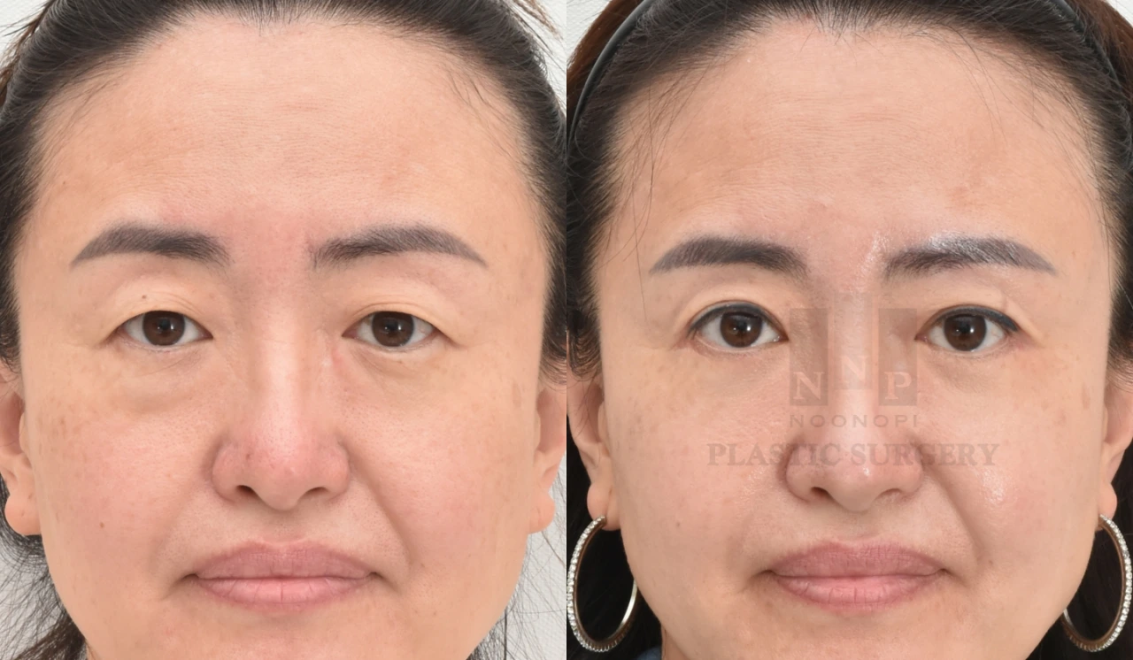 Before after of upper and lower blepharoplasty in middle age