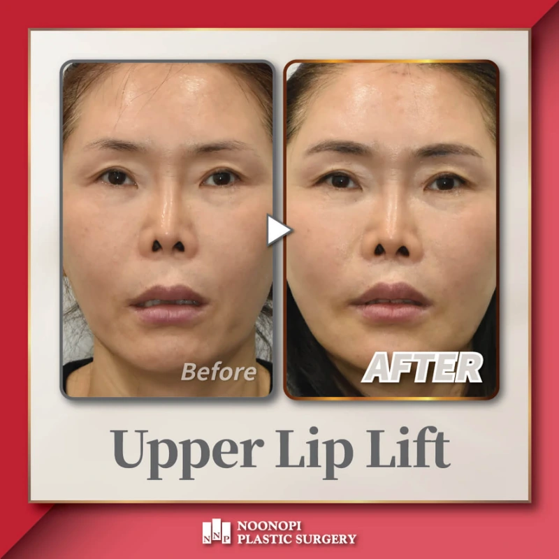 upper lip lift korea
