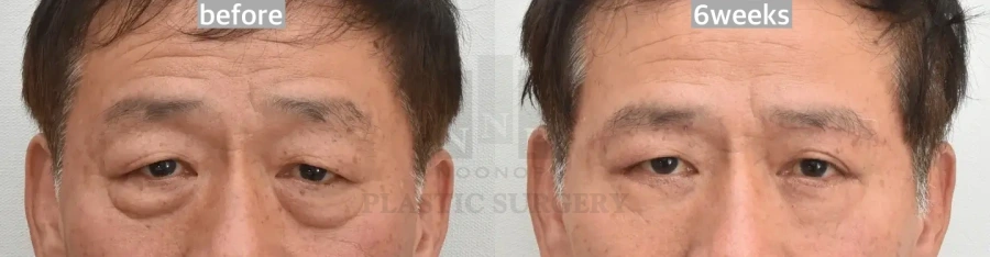 lower blepharoplasty before after