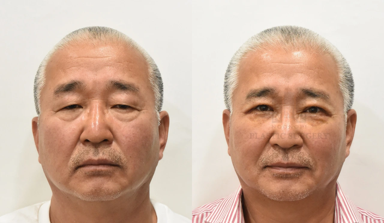 Day 7 after upper blepharoplasty