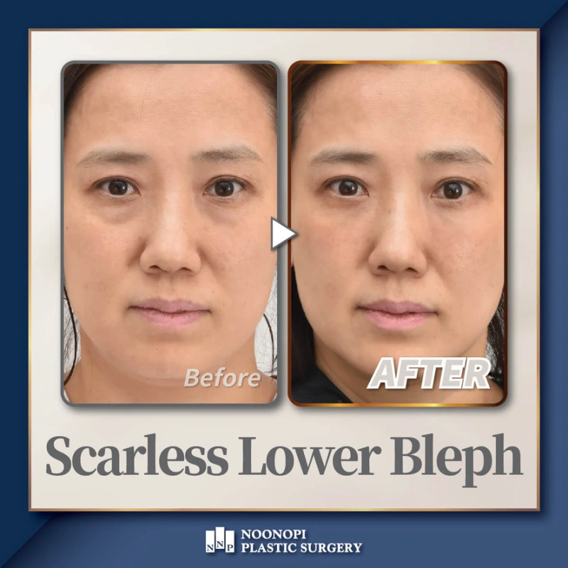 lower blepharoplasty Korea