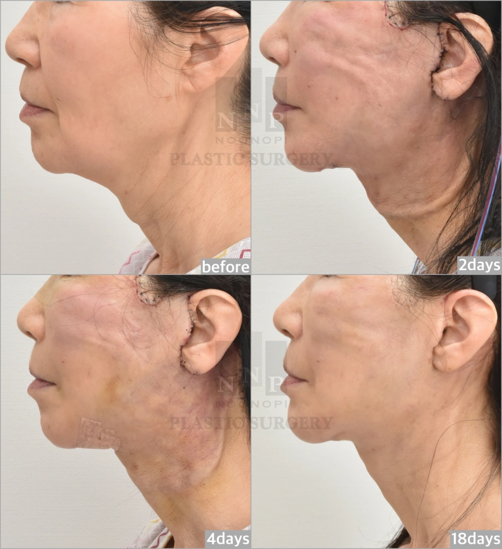 neck lift recovery picture day by day