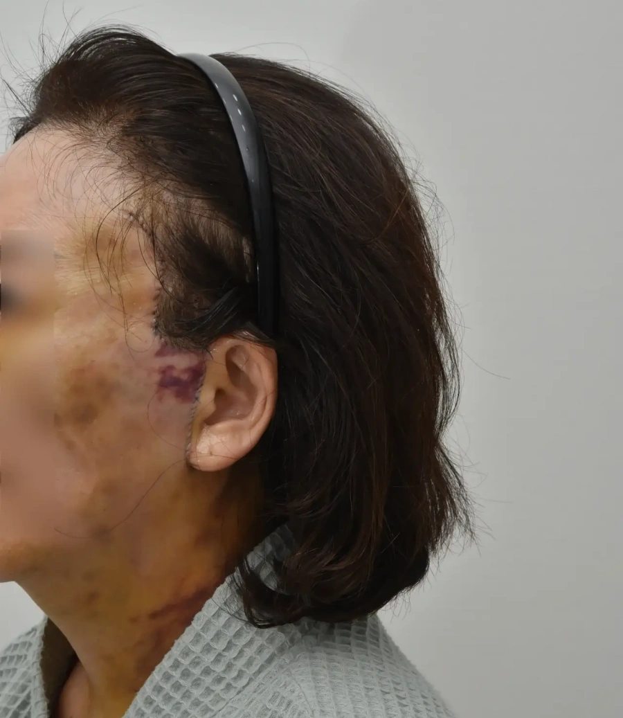 리팅 안면거상 후회