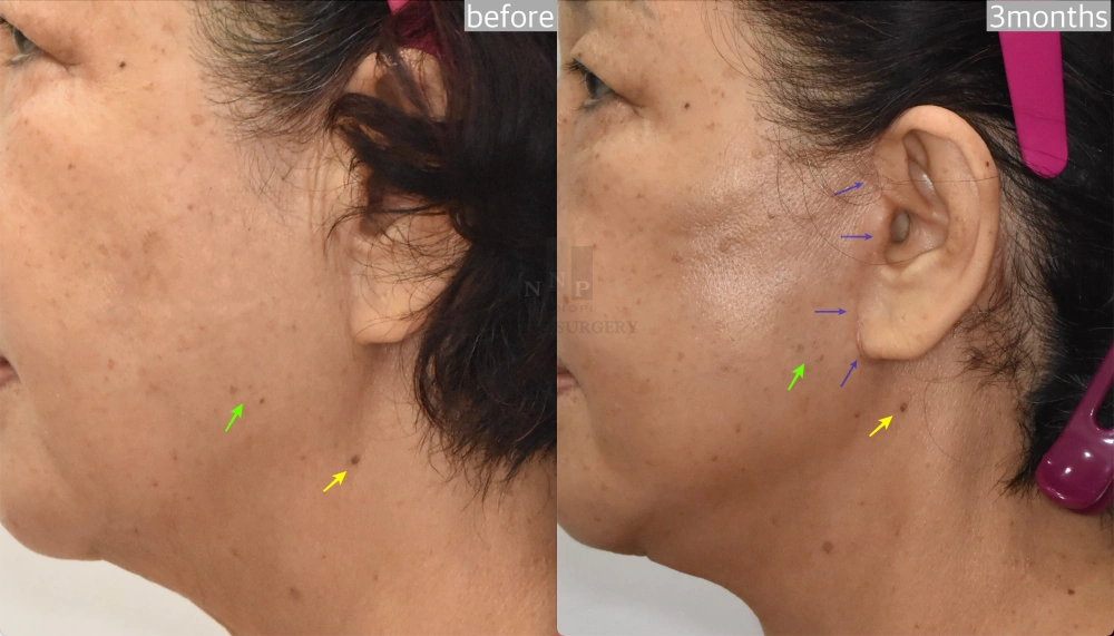 korean facelift before after