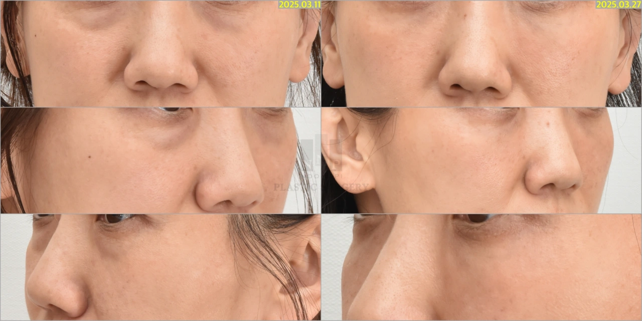 scarless lower blepharoplasty