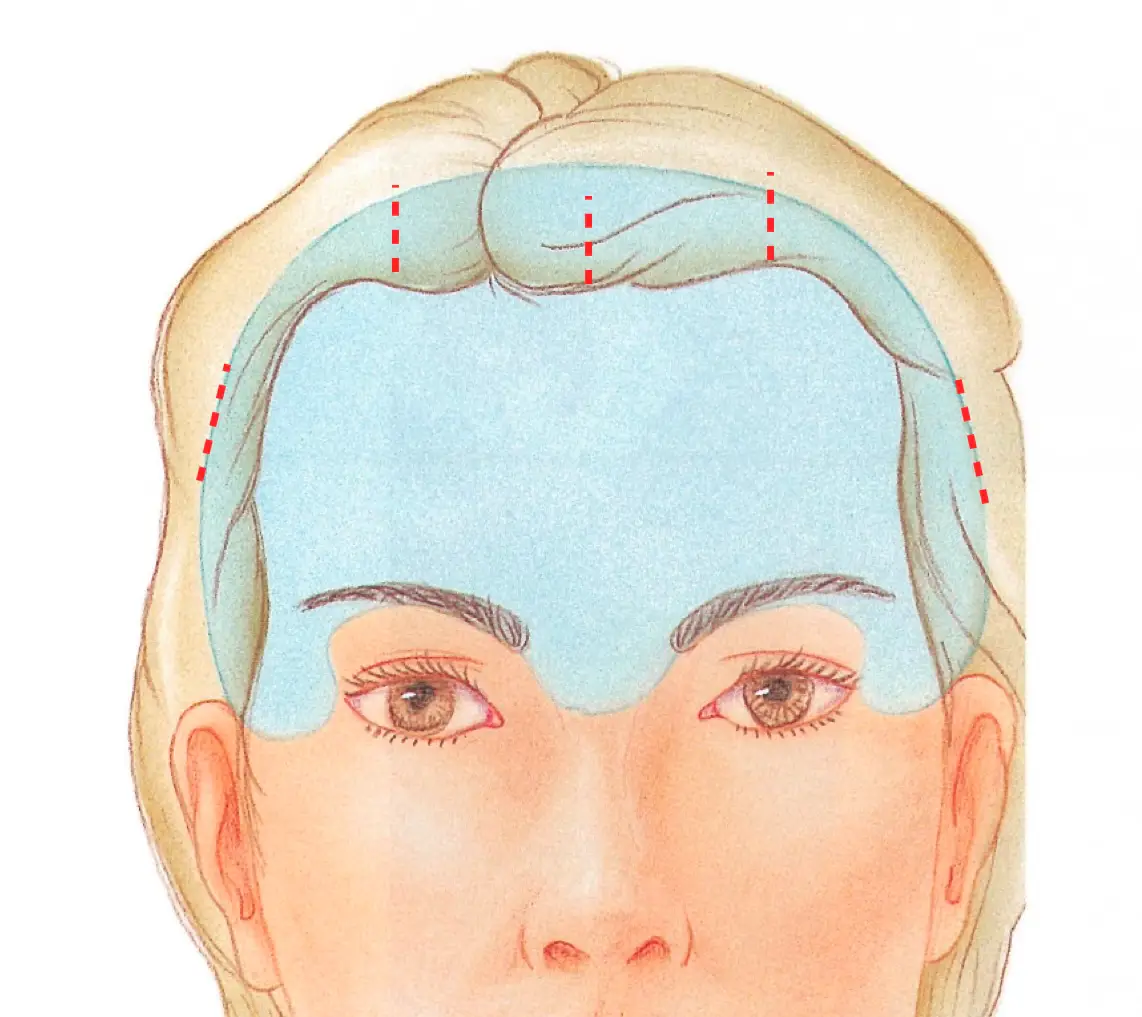 Incision placement behind the hairline