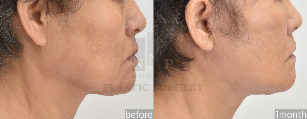 how to get rid of jowls