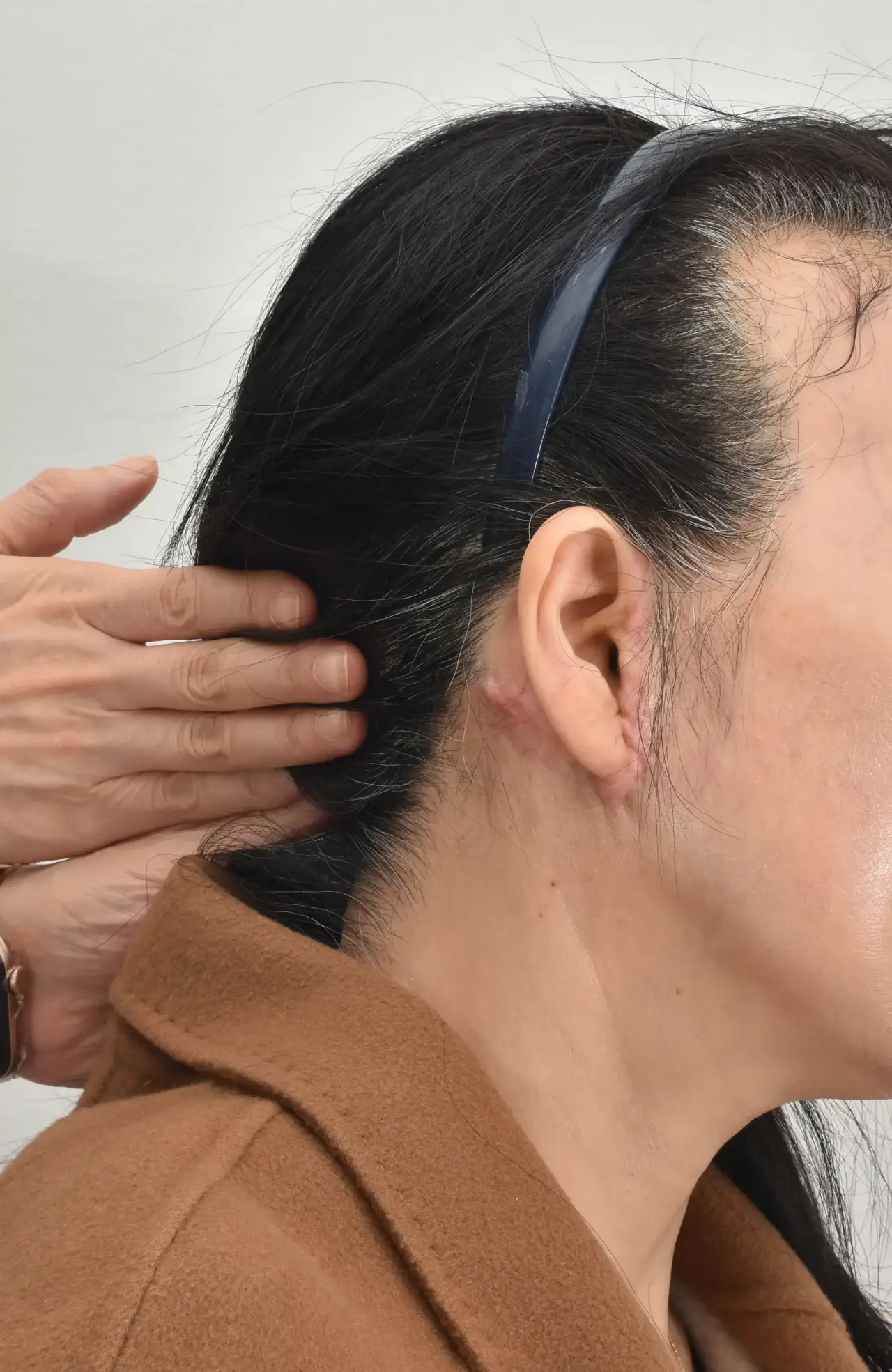 scar after mini face lift