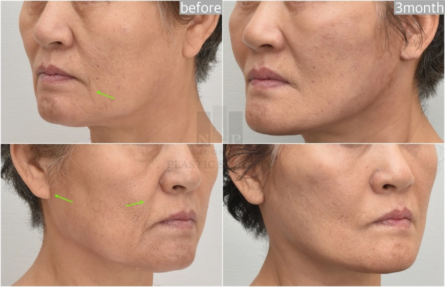 facelift korea before after