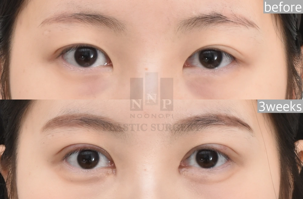 ptosis surgery korea
