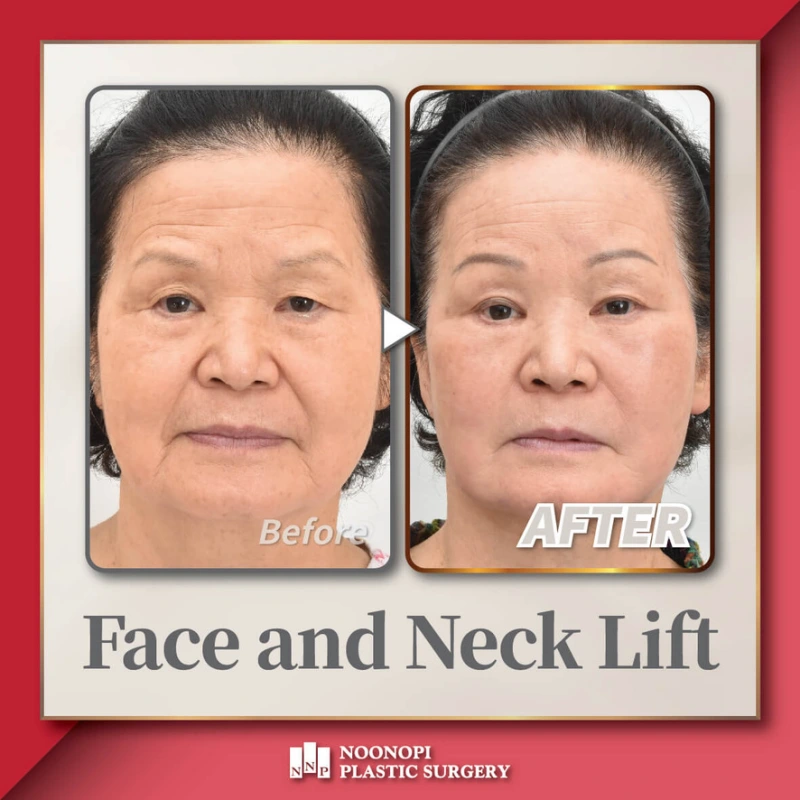 facelift korea