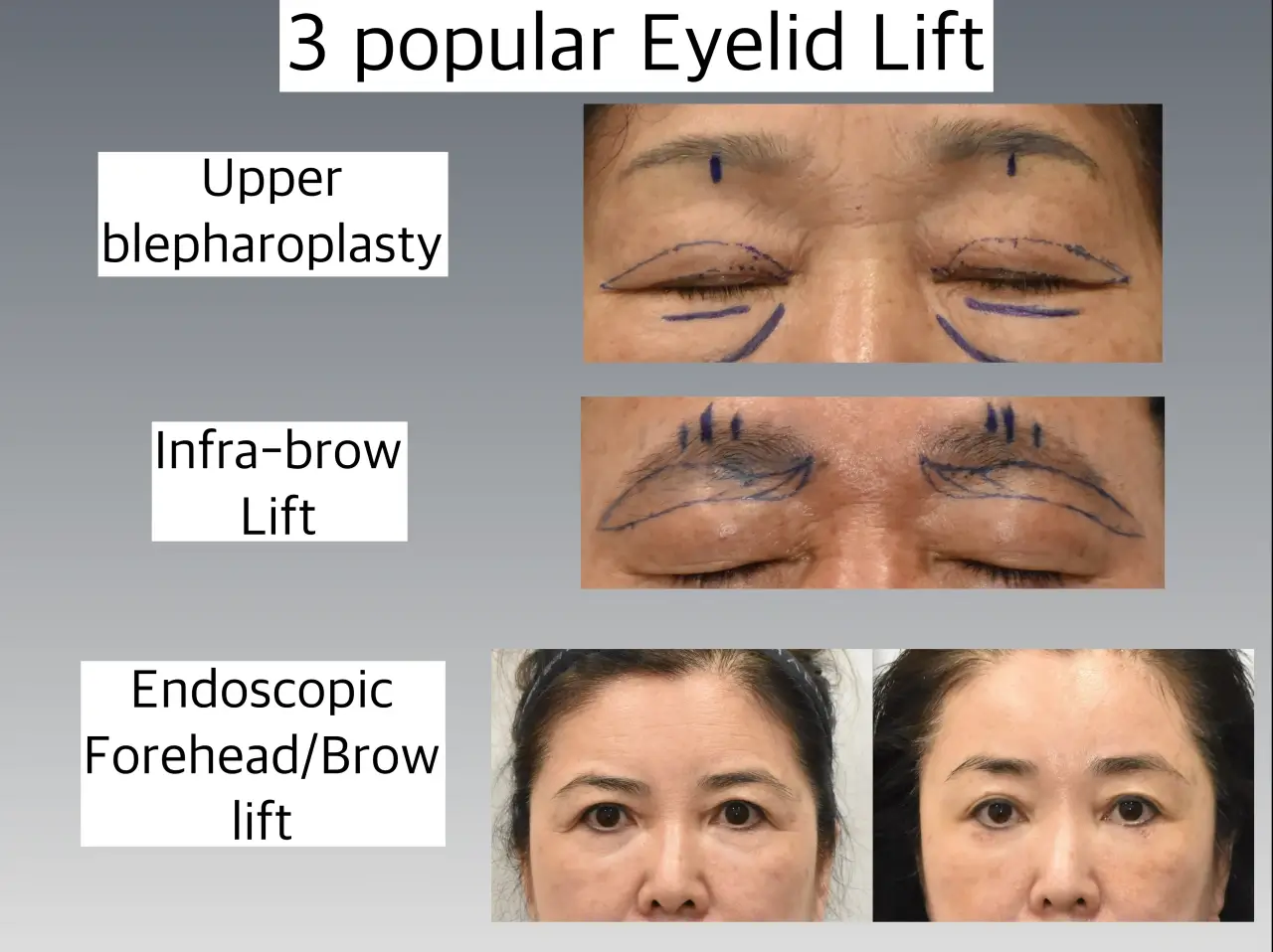 Eyelid lift procedures