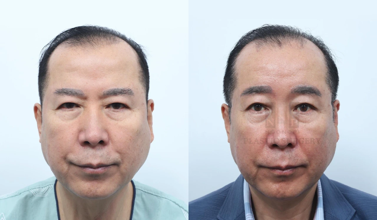 endoscopic forehead lift incision location