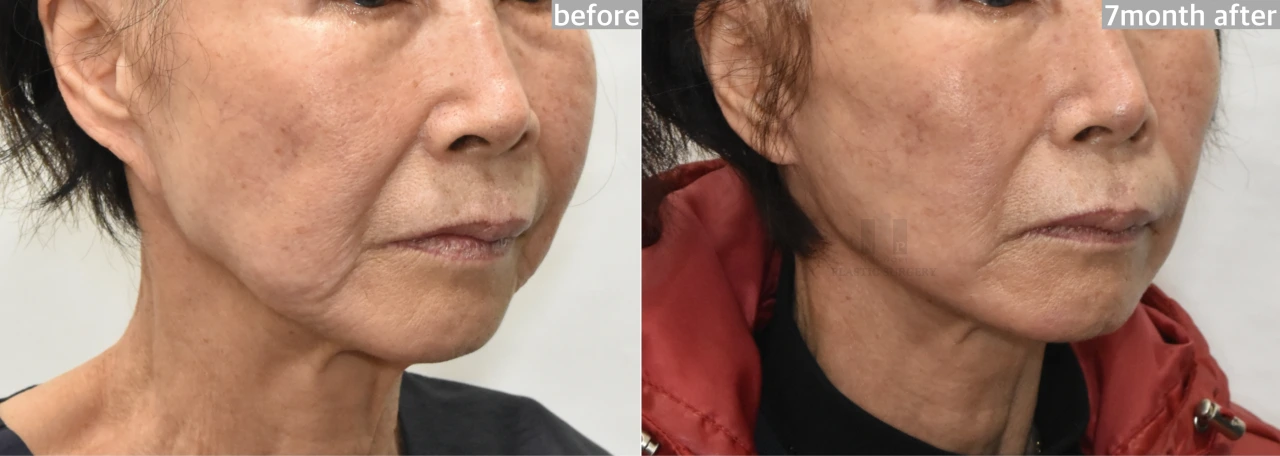 Facelift revision 7 months after