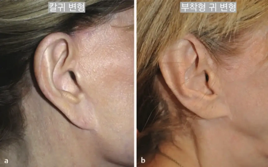 칼귀와 부착형 귀