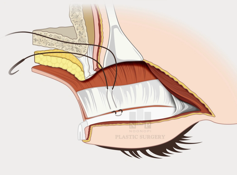 ptosis correction surgery principles