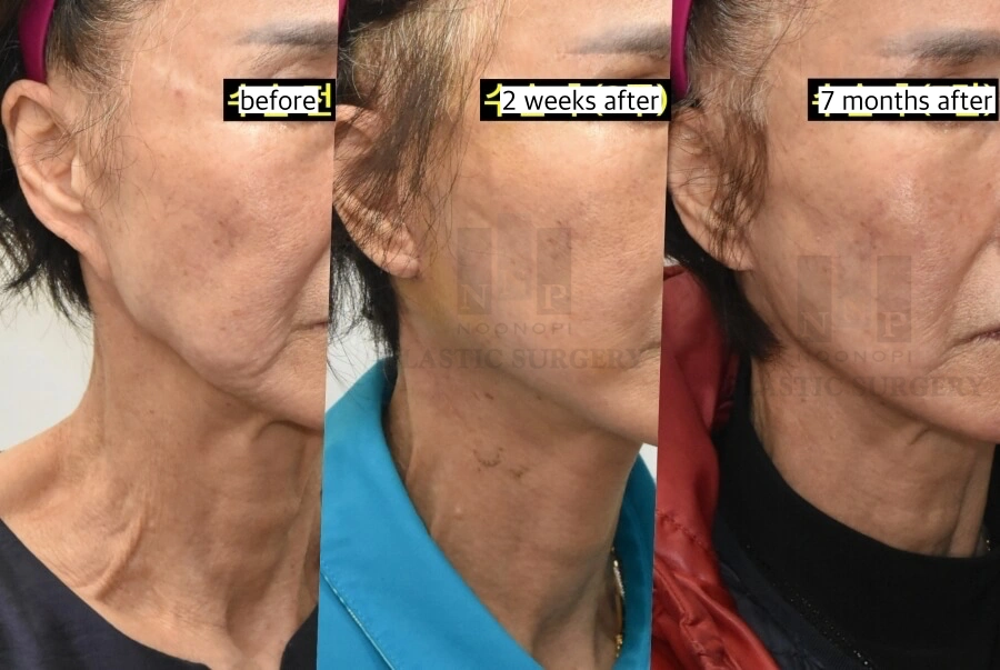 Pixie ear correction