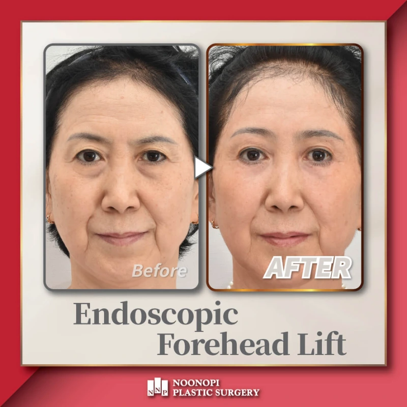 Under-eye fat grafting