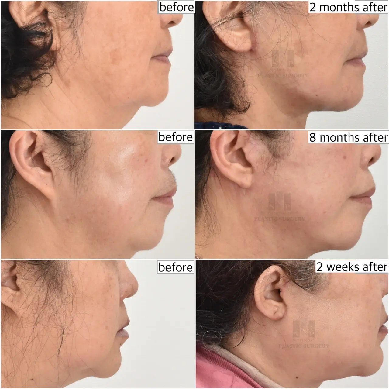 Key features of Korean Noonopi Plastic Surgery facelift