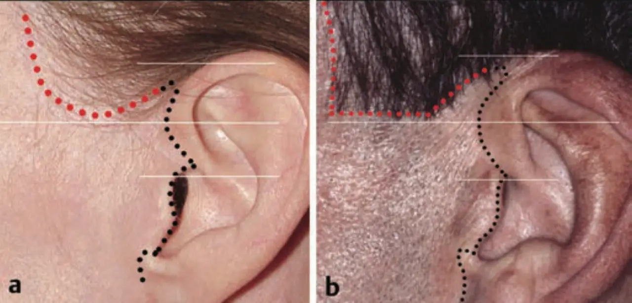 Recommended facelift incision for natural hairline