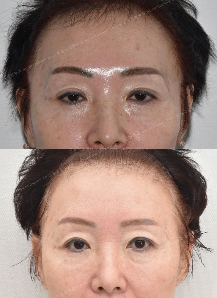 상안검 후기