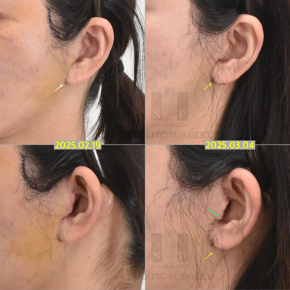 Posterior tragus incision scar healing example