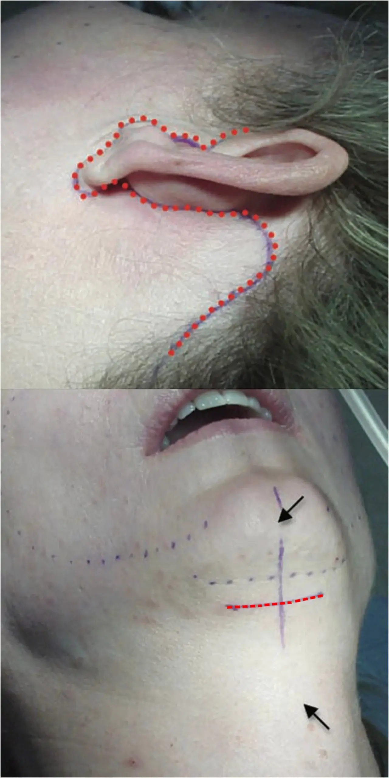 Extended neck lift incision location