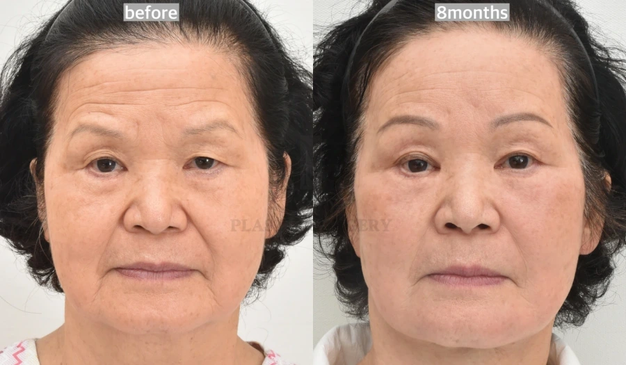 plastic surgery aftercare results
