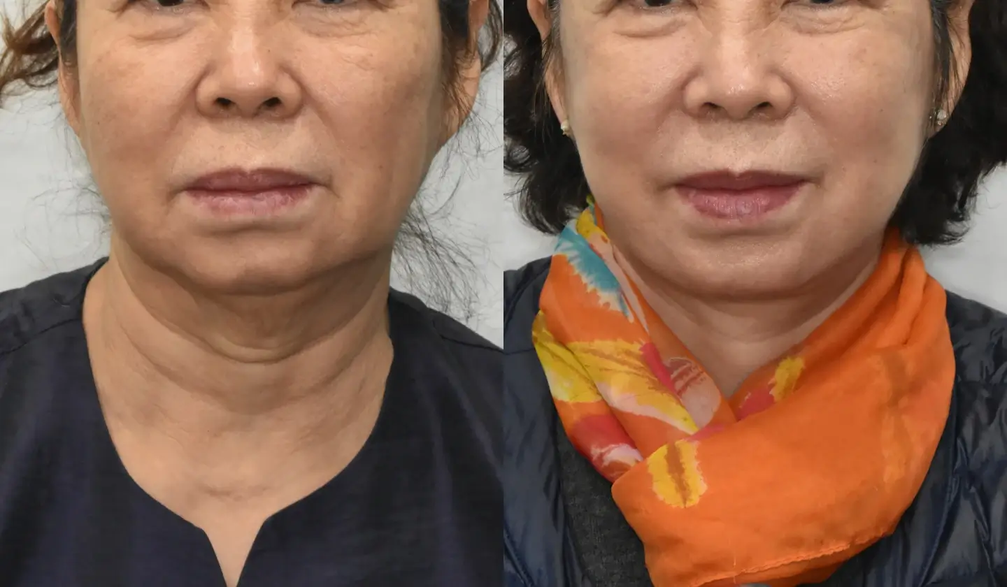 Korean facelift results