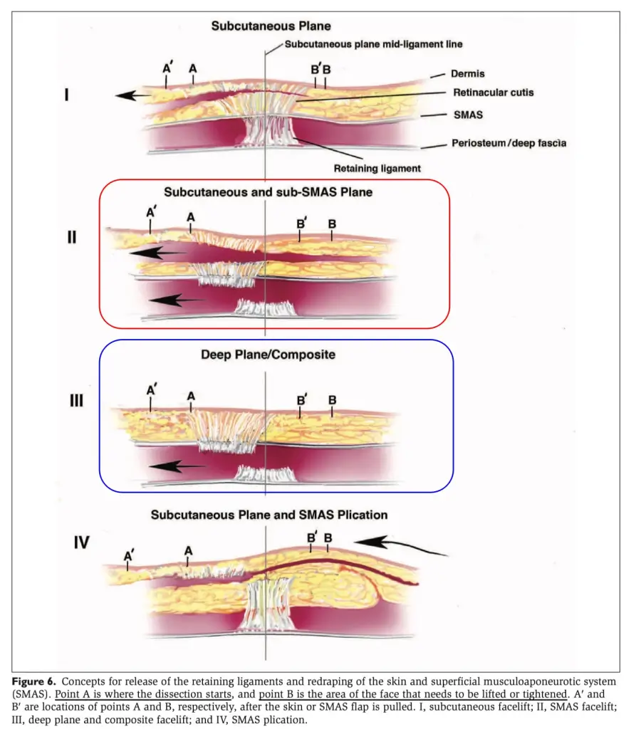 facelift types