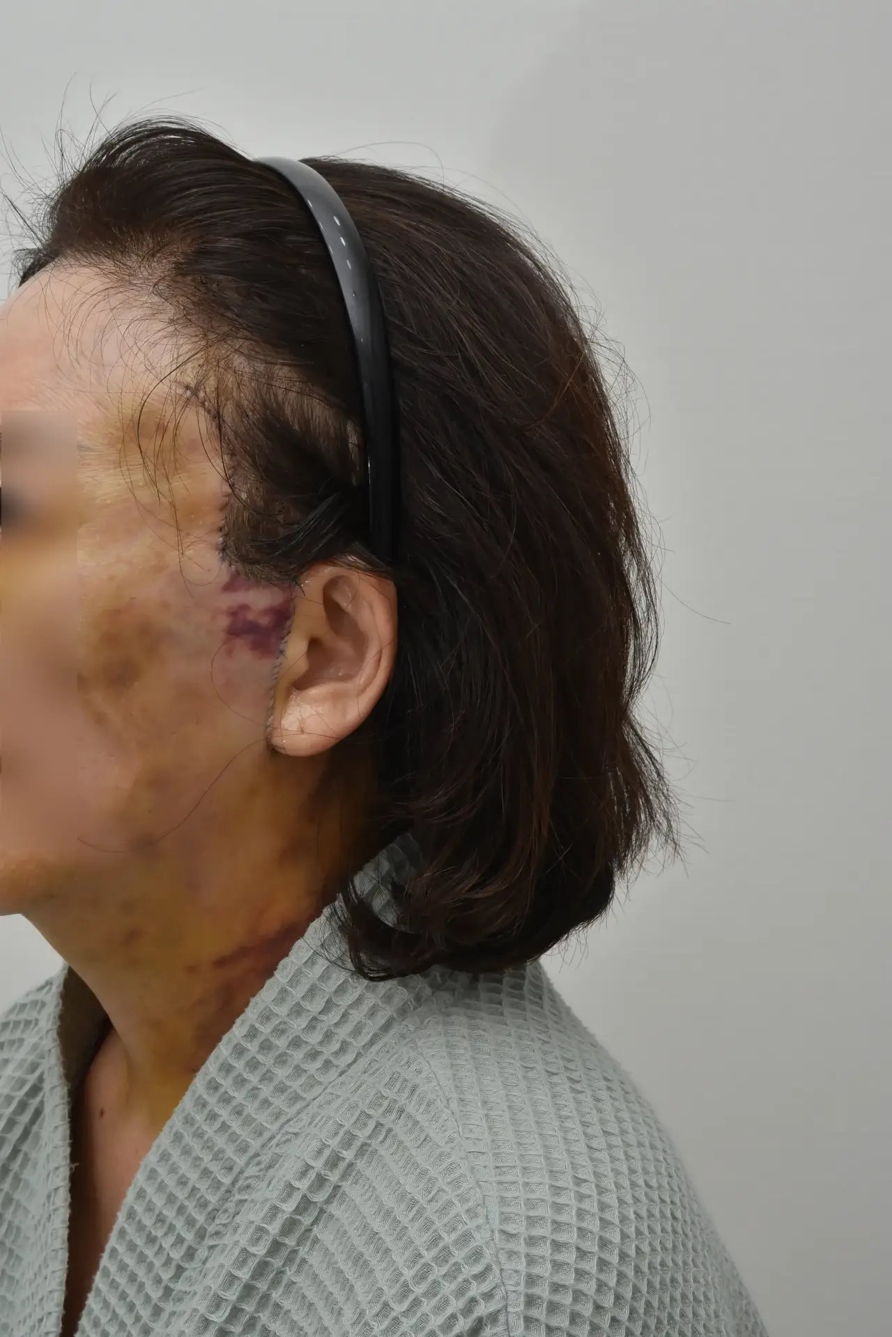 hyperbaric oxygen after facelift Korea