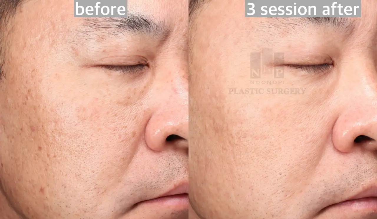 BBL HERO improves skin texture
