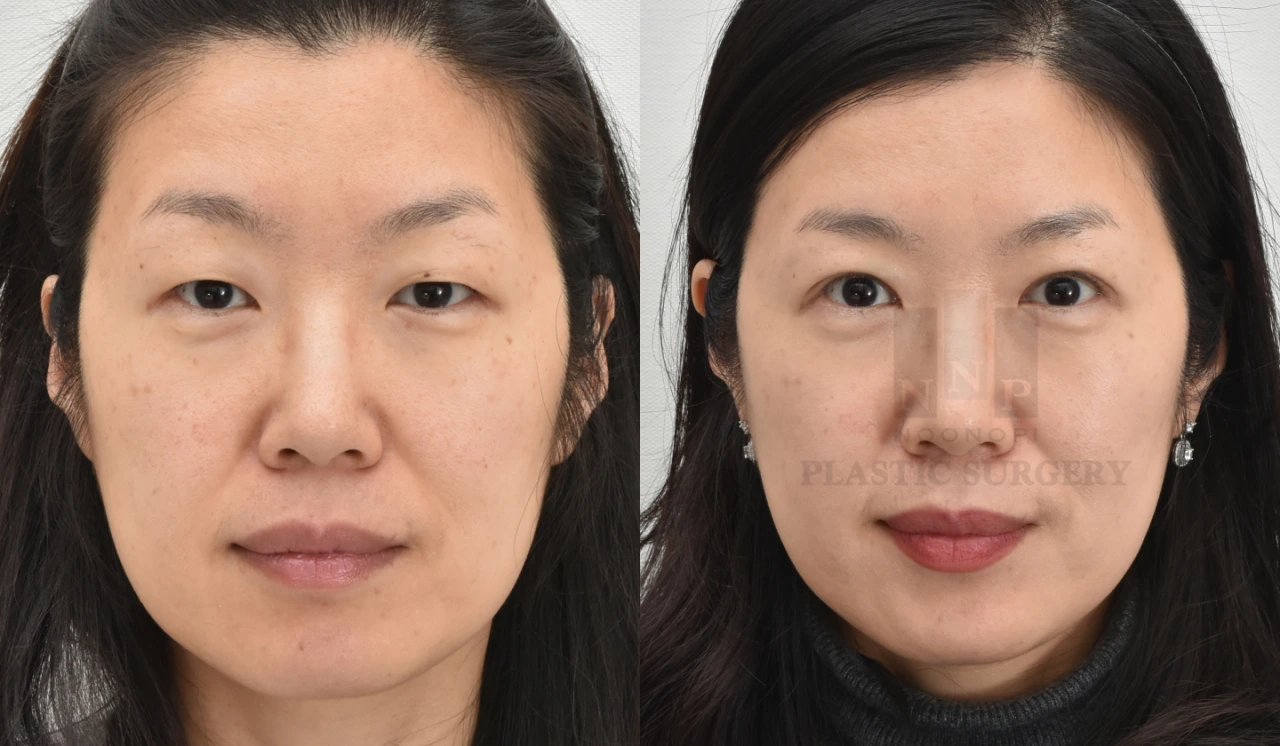before after blepharoplasty with ptosis correction
