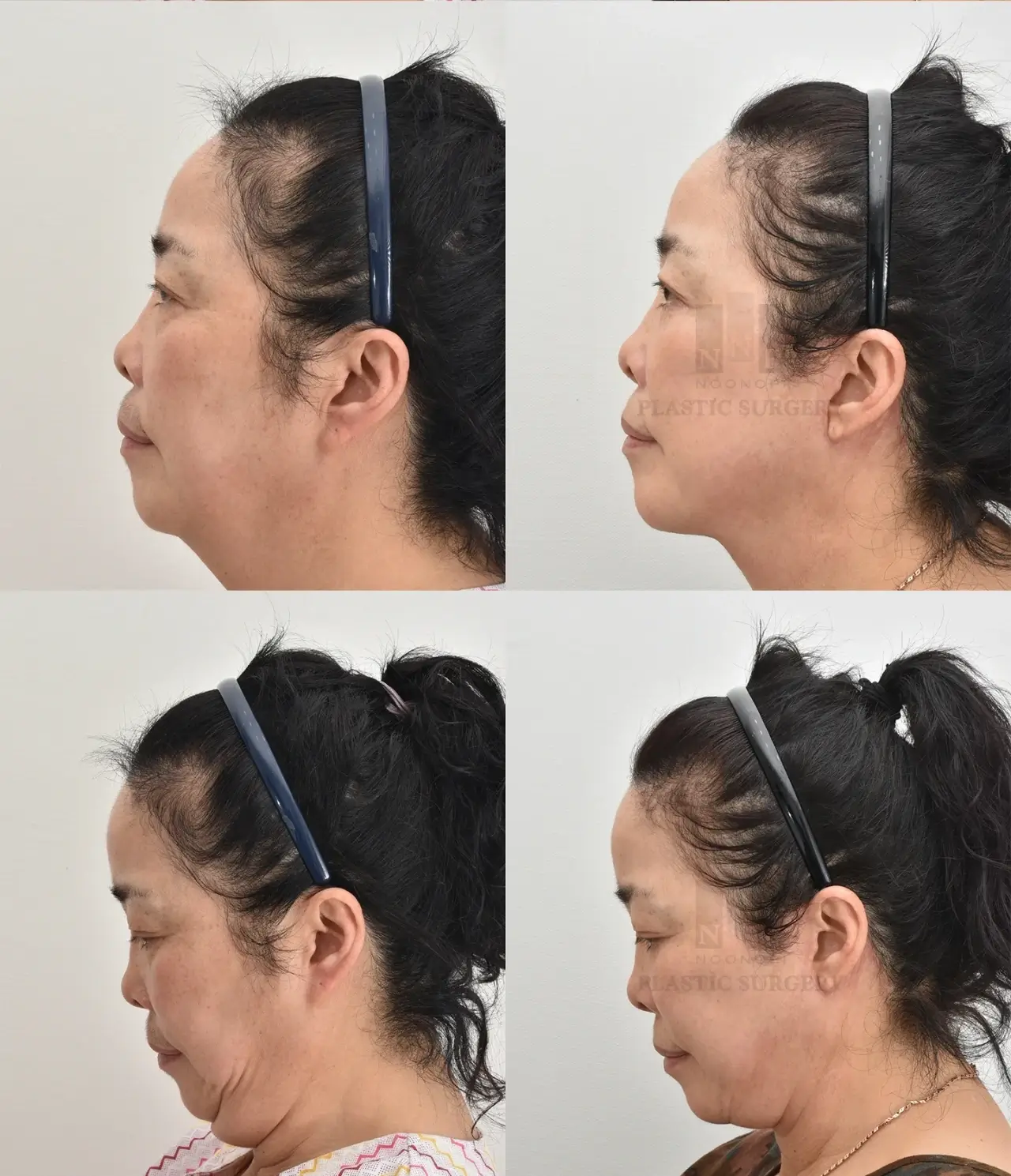 face and neck lift post 8 month