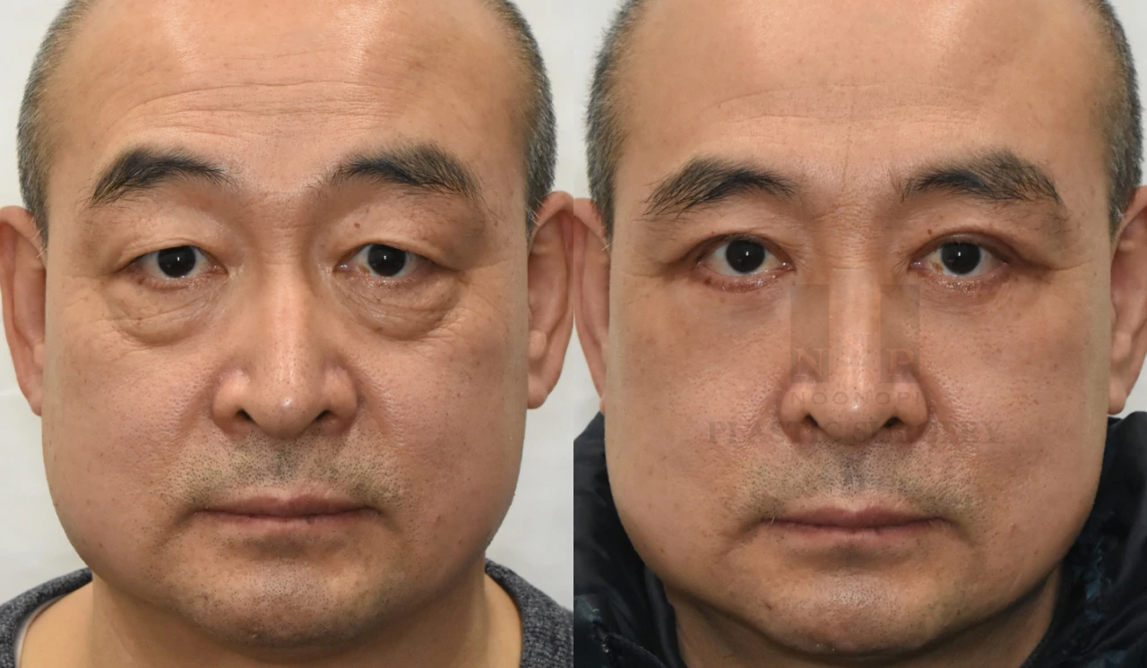 benefits of upper eyelid lift Korea