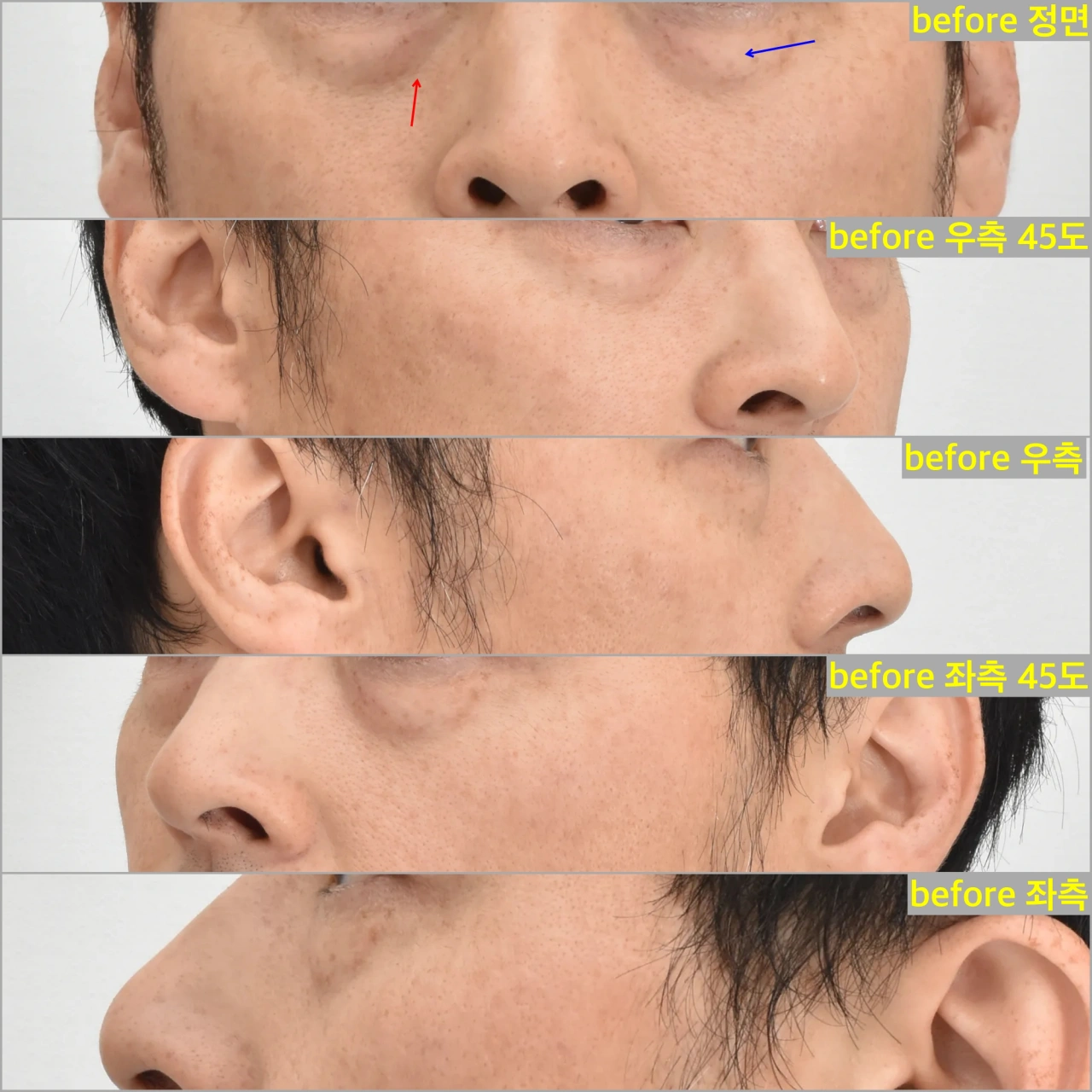 examples of eyebags