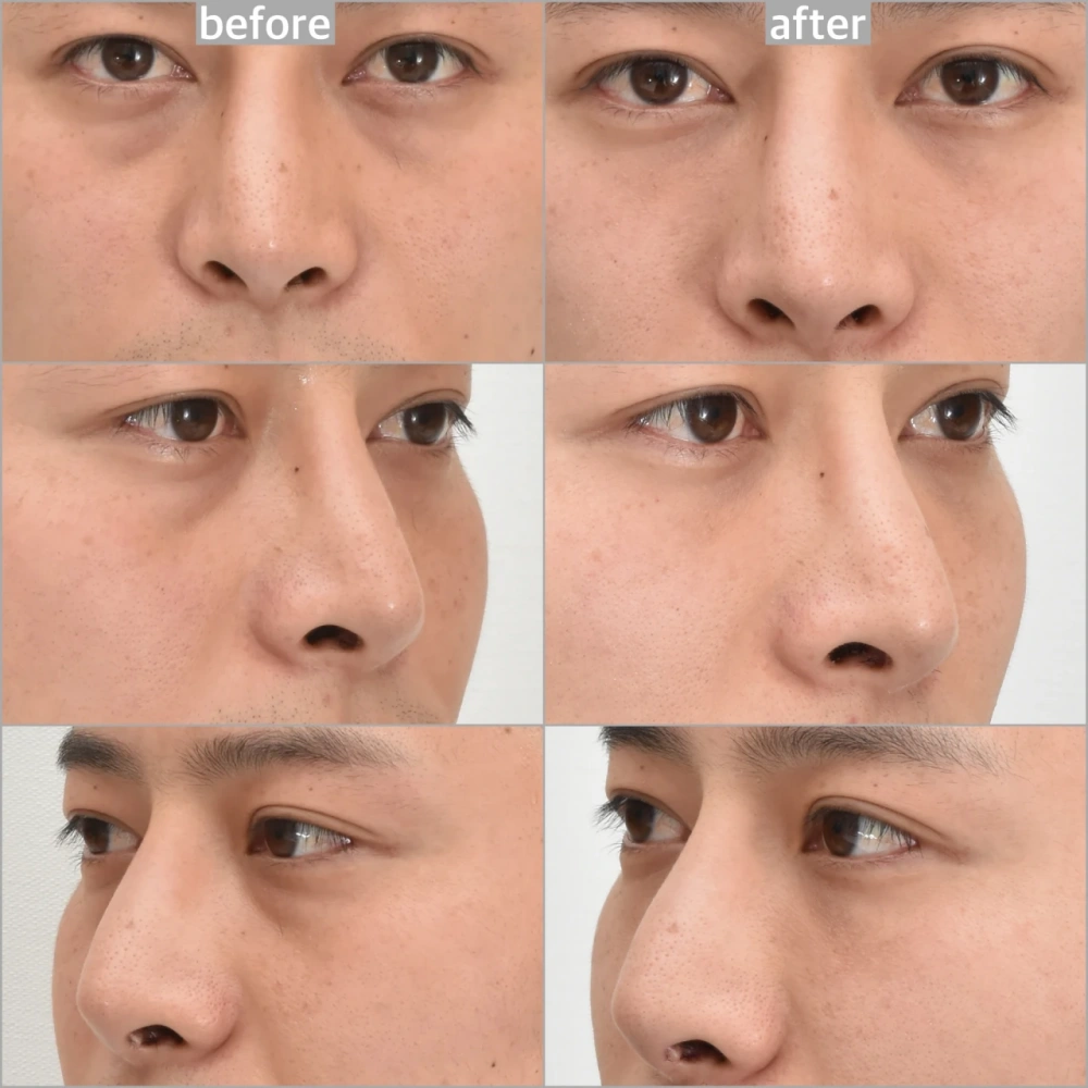 dark circle surgery