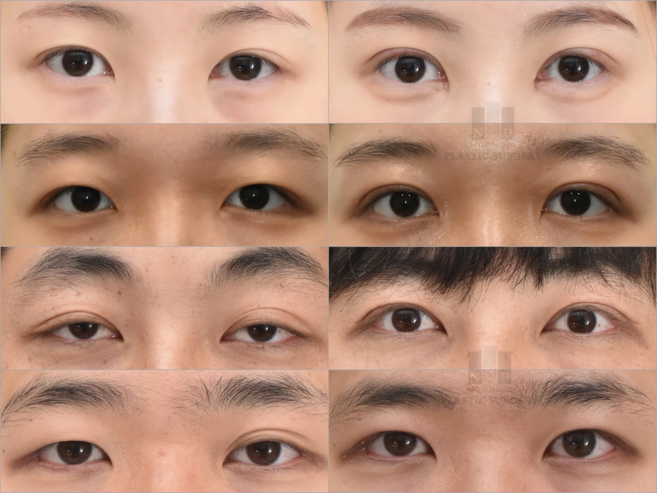 double fold incisional method before after