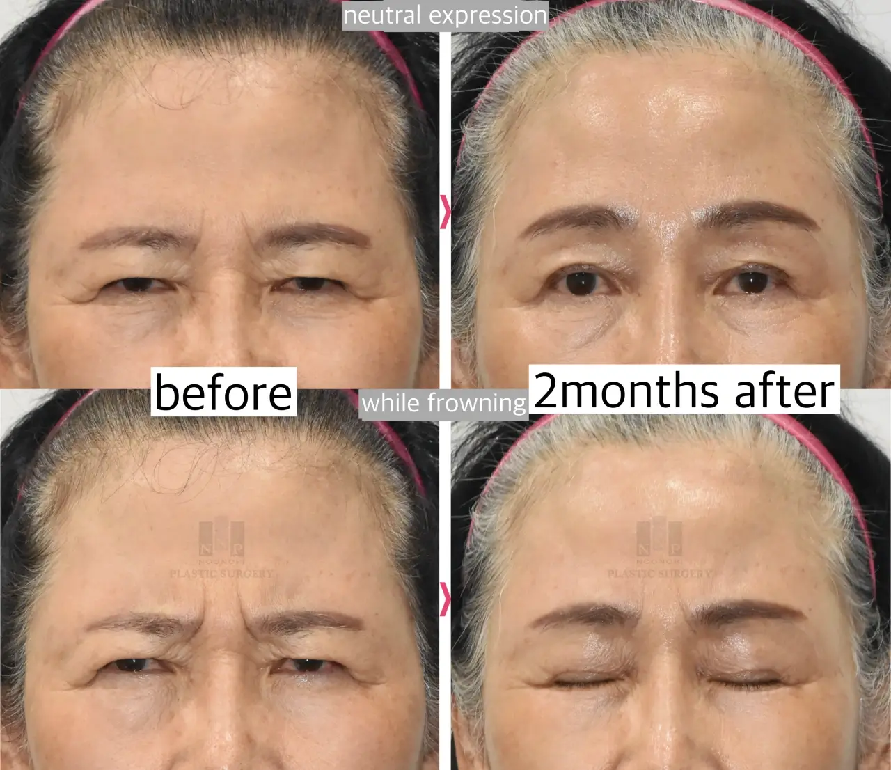 Mimicking the effect of Botox – frown line improvement